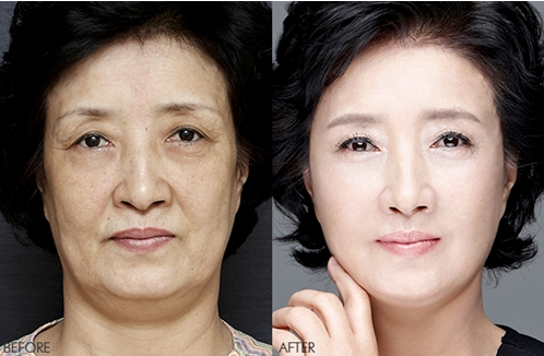  Grand Skin Care áp dụng phương pháp căng da mặt bằng chỉ hàng đầu tại Việt Nam
