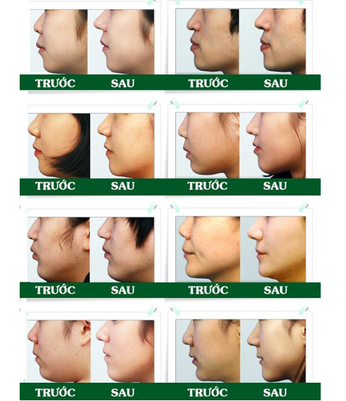 Nâng mũi không phẫu thuật bằng chất làm đầy Filler giúp cải thiện các khiếm khuyết của mũi
